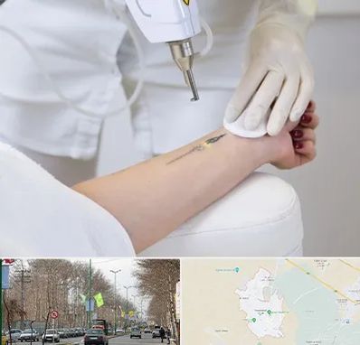 پاک کردن تتو با لیزر در نظرآباد کرج