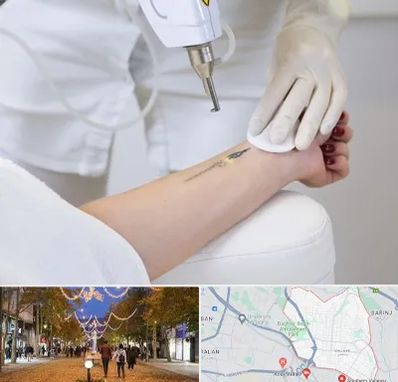 پاک کردن تتو با لیزر در ولیعصر ارومیه