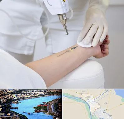 پاک کردن تتو با لیزر در خرمشهر