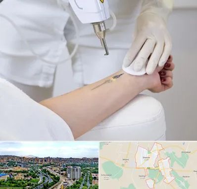 پاک کردن تتو با لیزر در شهریار