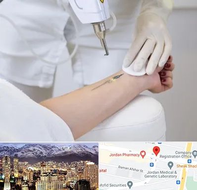 پاک کردن تتو با لیزر در جردن