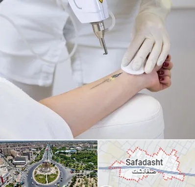 پاک کردن تتو با لیزر در صفادشت