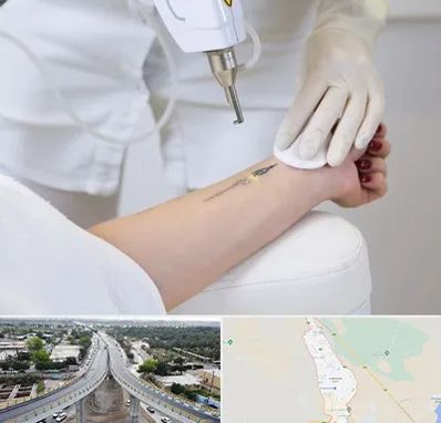 پاک کردن تتو با لیزر در اندیمشک