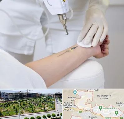 پاک کردن تتو با لیزر در پردیس