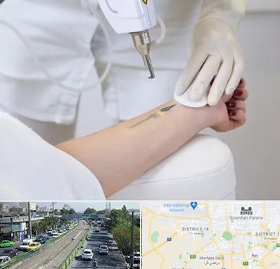 پاک کردن تتو با لیزر در جنوب تهران