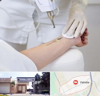 پاک کردن تتو با لیزر در وحیدیه شهریار