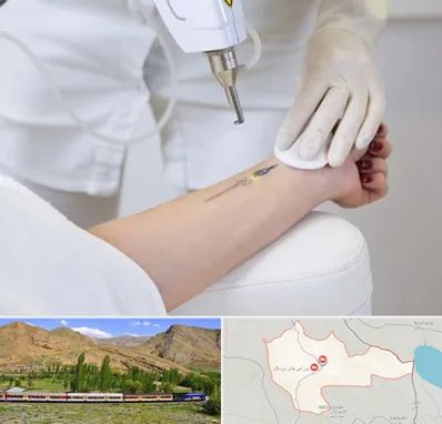 پاک کردن تتو با لیزر در خاش