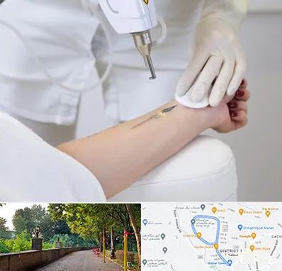 پاک کردن تتو با لیزر در بلوار گیلان رشت