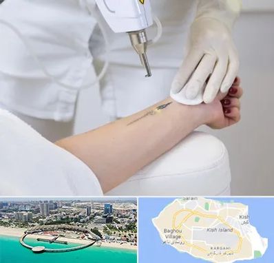 پاک کردن تتو با لیزر در کیش