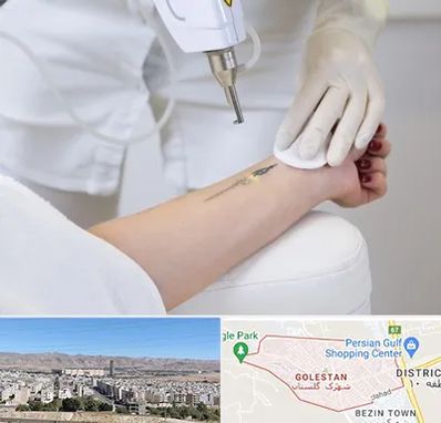 پاک کردن تتو با لیزر در شهرک گلستان شیراز