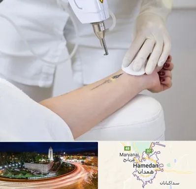 پاک کردن تتو با لیزر در همدان