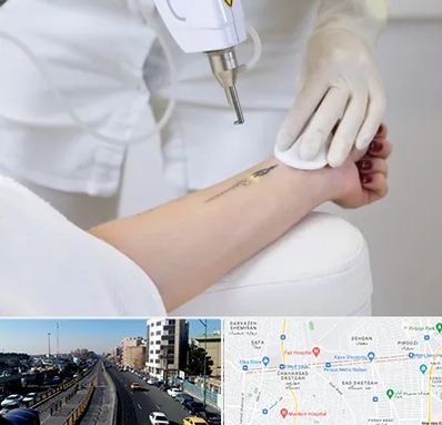 پاک کردن تتو با لیزر در پیروزی