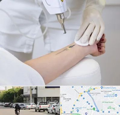 پاک کردن تتو با لیزر در قدوسی شرقی شیراز