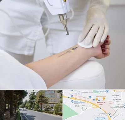 پاک کردن تتو با لیزر در مهرویلا کرج