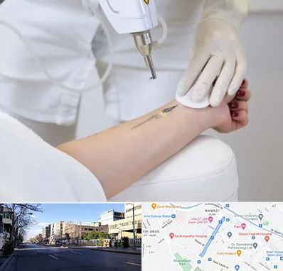 پاک کردن تتو با لیزر در خیابان ملاصدرا شیراز