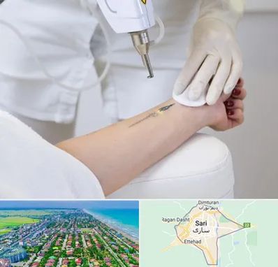 پاک کردن تتو با لیزر در ساری