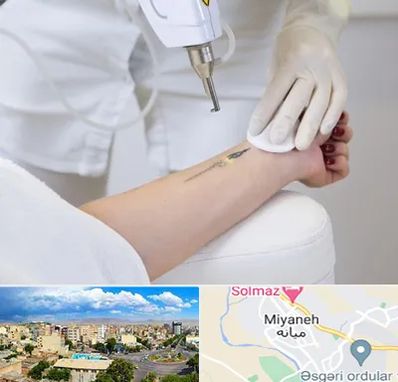 پاک کردن تتو با لیزر در میانه