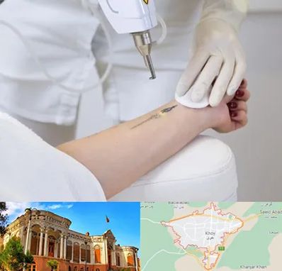 پاک کردن تتو با لیزر در خوی