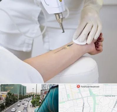 پاک کردن تتو با لیزر در بلوار فرحزادی