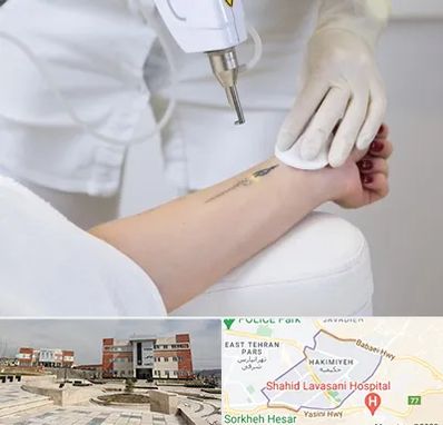 پاک کردن تتو با لیزر در حکیمیه