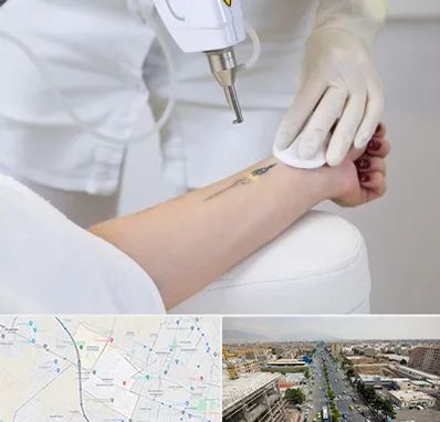 پاک کردن تتو با لیزر در حصارک کرج