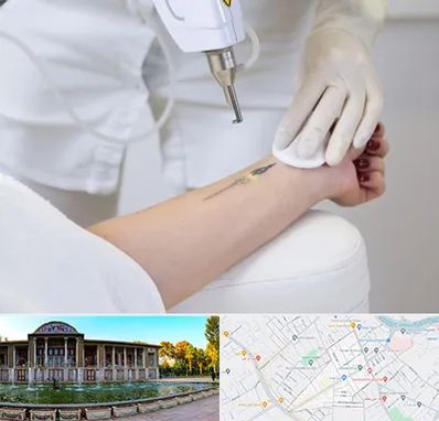 پاک کردن تتو با لیزر در عفیف آباد شیراز