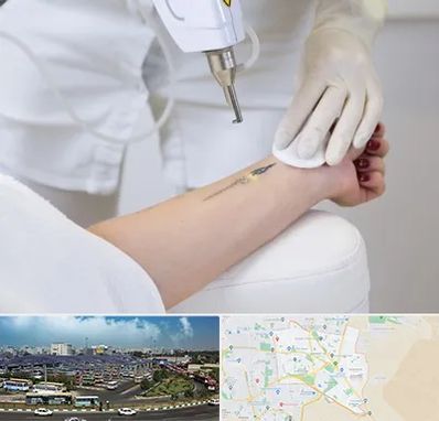 پاک کردن تتو با لیزر در منطقه 15 تهران