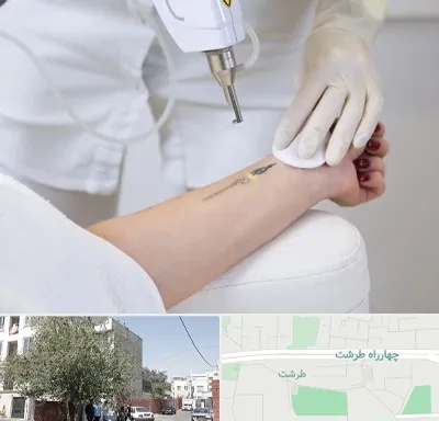 پاک کردن تتو با لیزر در طرشت