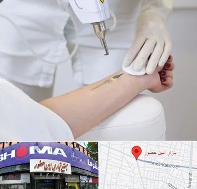 پاک کردن تتو با لیزر در امین حضور