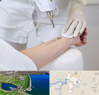 پاک کردن تتو با لیزر در مهاباد