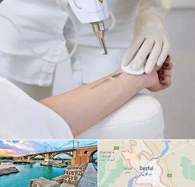 پاک کردن تتو با لیزر در دزفول