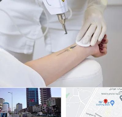 پاک کردن تتو با لیزر در چهارراه طالقانی کرج