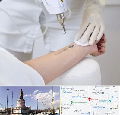 پاک کردن تتو با لیزر در کارگر جنوبی