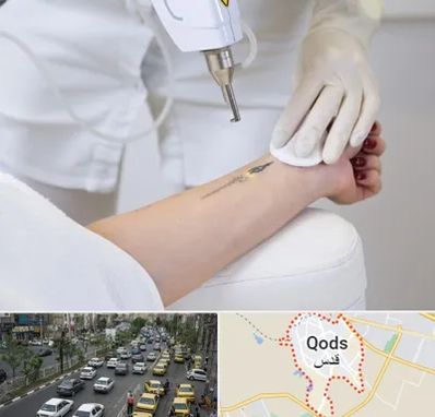 پاک کردن تتو با لیزر در شهر قدس