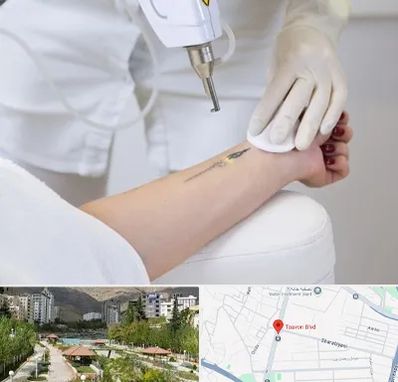 پاک کردن تتو با لیزر در بلوار تعاون