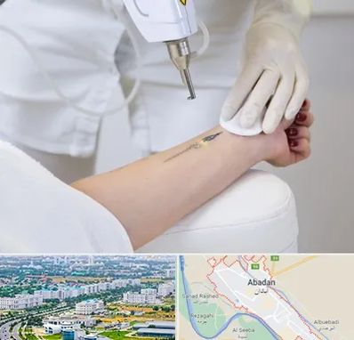 پاک کردن تتو با لیزر در آبادان