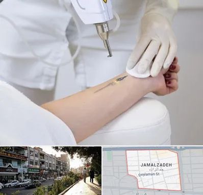 پاک کردن تتو با لیزر در خیابان جمالزاده