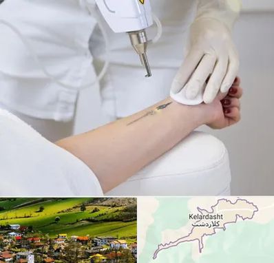 پاک کردن تتو با لیزر در کلاردشت