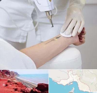 پاک کردن تتو با لیزر در هرمزگان