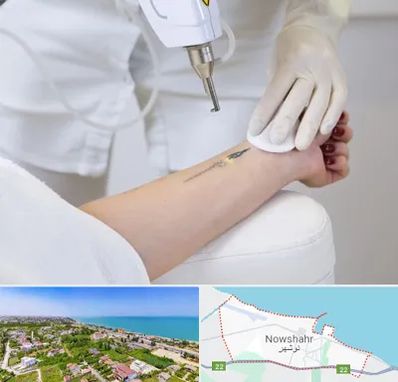 پاک کردن تتو با لیزر در نوشهر