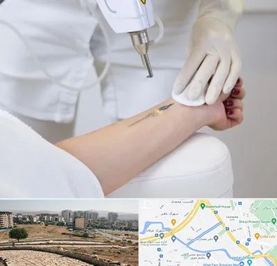 پاک کردن تتو با لیزر در کوی وحدت شیراز