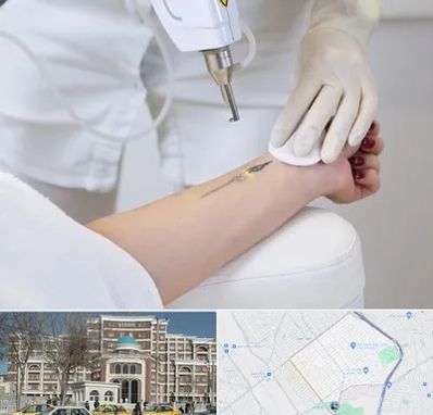 پاک کردن تتو با لیزر در طلاب مشهد