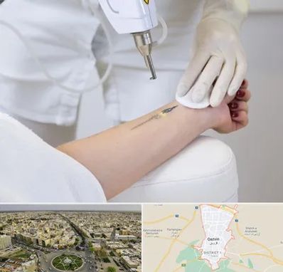 پاک کردن تتو با لیزر در قزوین