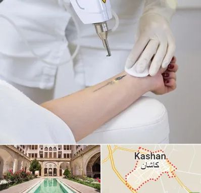 پاک کردن تتو با لیزر در کاشان