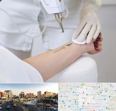 پاک کردن تتو با لیزر در منطقه 7 تهران