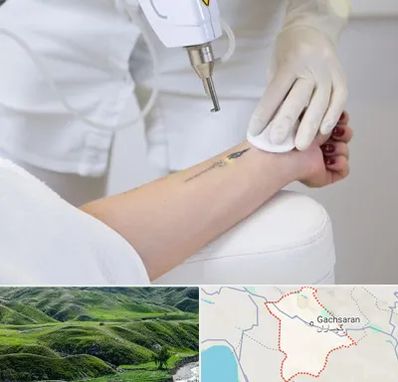 پاک کردن تتو با لیزر در گچساران
