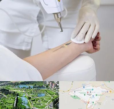 پاک کردن تتو با لیزر در بجنورد