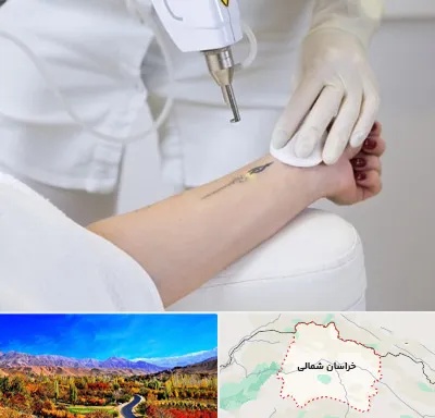 پاک کردن تتو با لیزر در خراسان شمالی