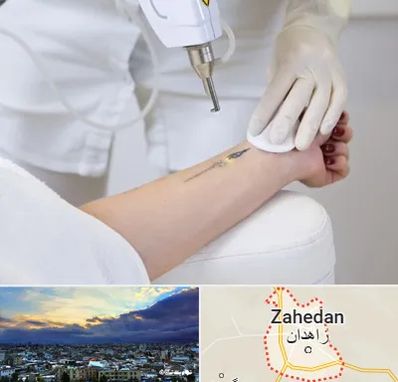 پاک کردن تتو با لیزر در زاهدان