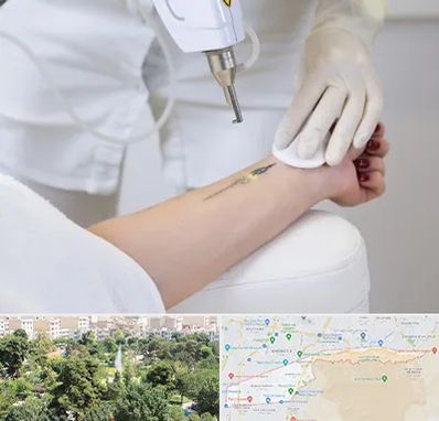 پاک کردن تتو با لیزر در منطقه 13 تهران